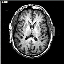 W. Logan Fry axial MRI brain scan through middle of corpus striatum